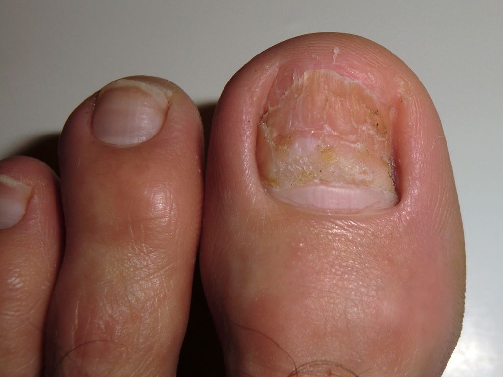 Ingrown Toenail Causes And Treatments Boulder County Foot Ankle